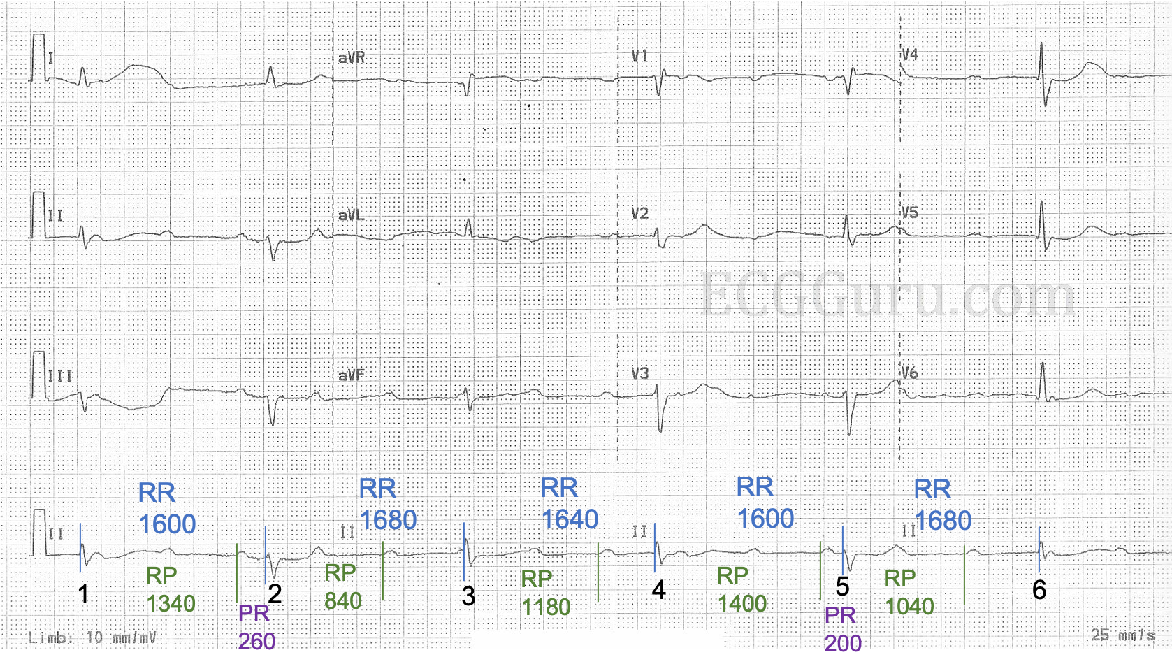 Complete Heart Block or High Grade AVB? ECG Guru Instructor Resources